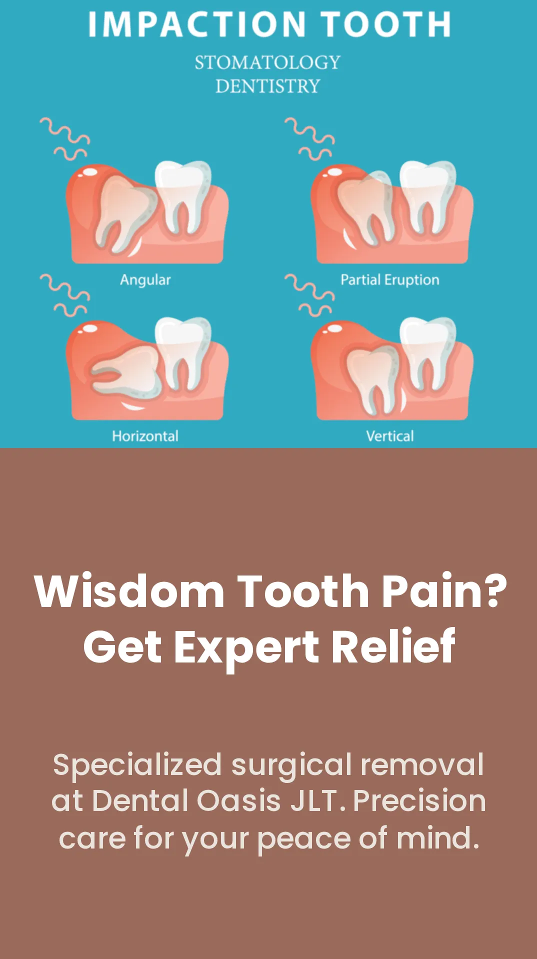 Wisdom Tooth Illustration