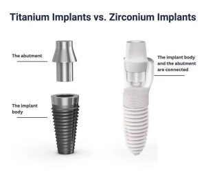 The Great Debate: Zirconia vs. Titanium Dental Implants—Which is Truly the Gold Standard in 2026?