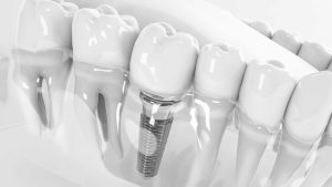 Dental Implant Cost in Dubai 2026: Why Quality and Experience Define Your Investment