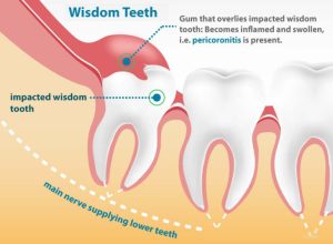 Wisdom Tooth Removal in Dubai: Clear Pricing, Safe Extraction at Dental Oasis, JLT