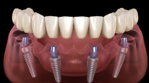 All-on-4 Dental Implants in Dubai:A Complete Arch of Teeth. 4 Implants. One Day.
