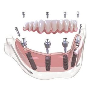All-on-6 Dental Implants in Dubai: 6 Implants. Superior Strength. A Complete Smile.