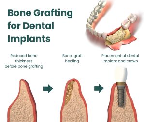 Bone Grafting Before Implants: Why a Weak Jaw Needs Reinforcement Before You Can Rebuild Your Smile
